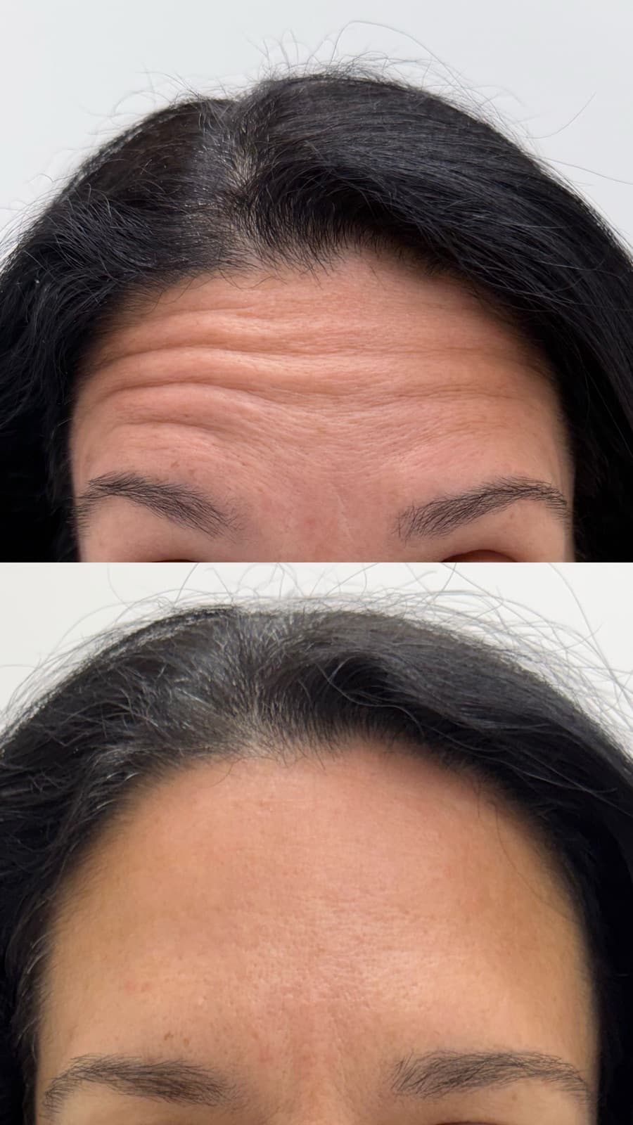 Botox treating forehead and frown lines