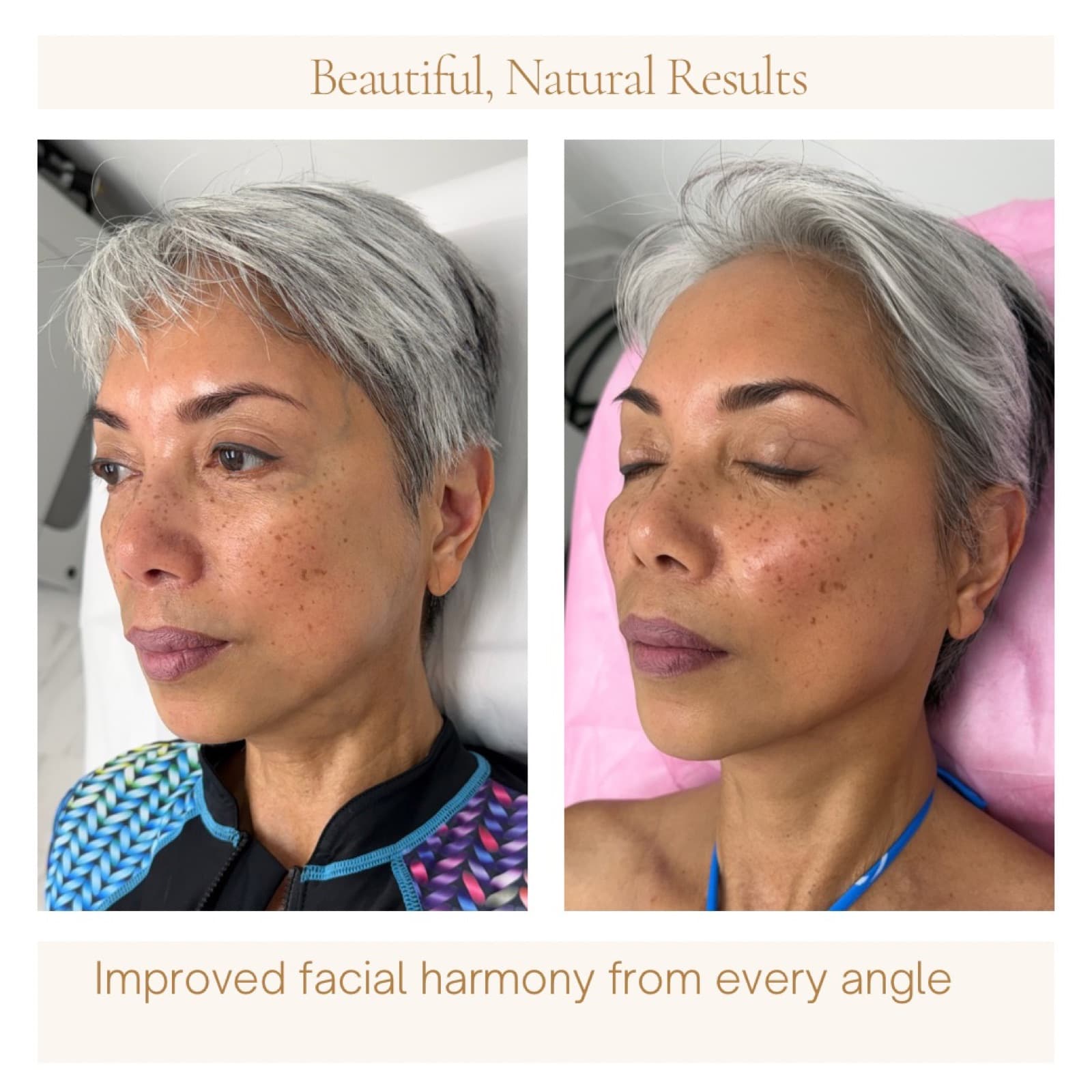 Cheek filler placed for facial rebalancing