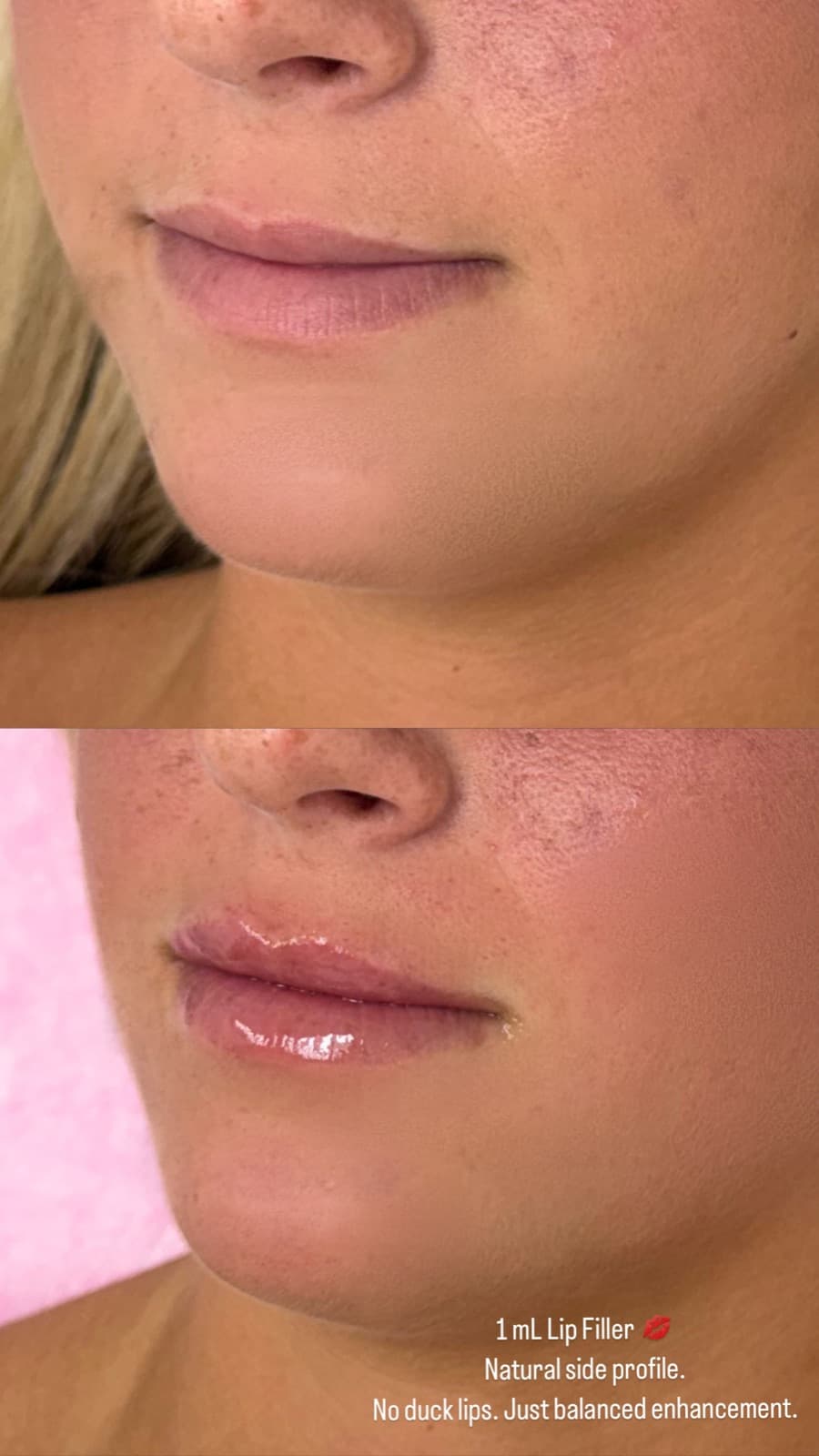 A one millilitre Restylane lip enhancement